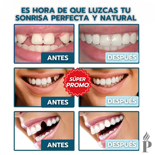 2x1 Carillas Dentales: La Solución Perfecta para una Sonrisa Impecable