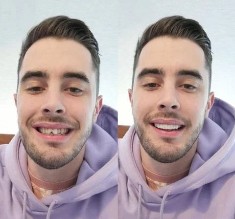 2x1 Carillas Dentales: La Solución Perfecta para una Sonrisa Impecable